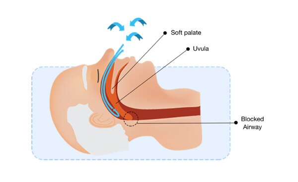 Soft Palate